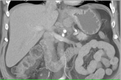 Gastric Cancer in the Fundus With Nodes - CTisus CT Scan