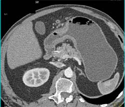 Linitis Plastica - CTisus CT Scan