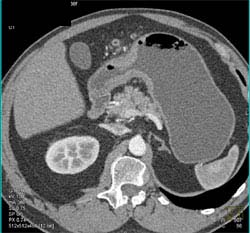 Linitis Plastica - CTisus CT Scan