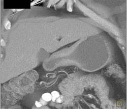 Linitis Plastica - CTisus CT Scan