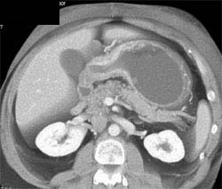 Linitis Plastica - CTisus CT Scan