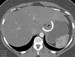 Vanguard Device- for Gastric Weight Reduction - CTisus CT Scan