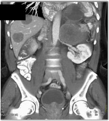 Recurrent GIST Tumor With Implants - CTisus CT Scan