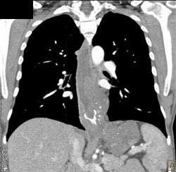 Achalasia - CTisus CT Scan