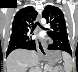 Achalasia - CTisus CT Scan