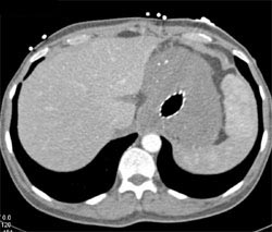 Achalasia With Tumor at Gastroesophageal (GE) Junction - CTisus CT Scan