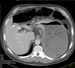 Antral Cancer - CTisus CT Scan