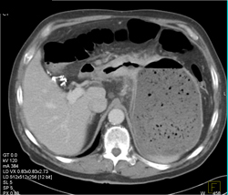 Antral Cancer - CTisus CT Scan