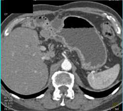 Antral Cancer - CTisus CT Scan