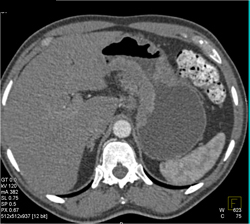 Antral Cancer - CTisus CT Scan