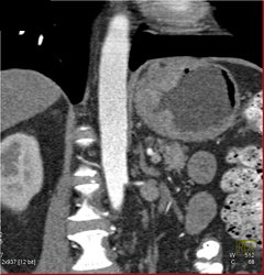 Antral Cancer - CTisus CT Scan