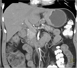 Antral Cancer - CTisus CT Scan