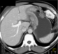 Antral Cancer - CTisus CT Scan