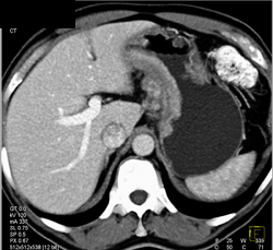 Antral Cancer - CTisus CT Scan