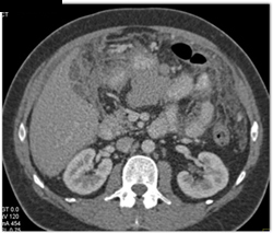 Carcinomatosis - CTisus CT Scan