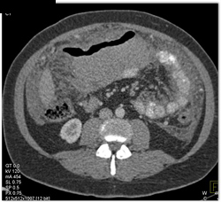 Carcinomatosis - CTisus CT Scan