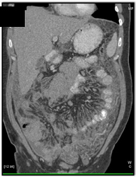 Carcinoid in Mesentery - CTisus CT Scan