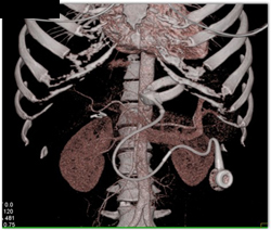 Carcinoid in Mesentery- Vanguard Device - CTisus CT Scan