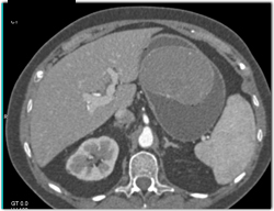 Gastric and Exogastric GIST Tumors of the Stomach - CTisus CT Scan