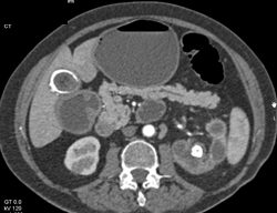 Gastric GIST Tumor and Gastric Outlet Obstruction - CTisus CT Scan