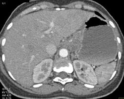 Gastric Adenocarcinoma - CTisus CT Scan