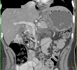 Gastric Adenocarcinoma - CTisus CT Scan