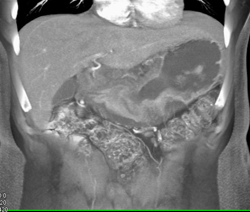 Gastric Adenocarcinoma - CTisus CT Scan