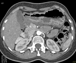 Gastric Adenocarcinoma - CTisus CT Scan