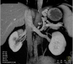 Gastric Varices - CTisus CT Scan