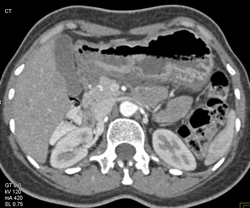 Gastric Varices - CTisus CT Scan