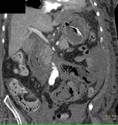 Gastric Cancer Fundus and Carcinomatosis and Pneumatosis Colon - CTisus CT Scan