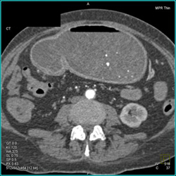 Antral Carcinoma - CTisus CT Scan