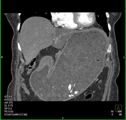 Antral Carcinoma - CTisus CT Scan