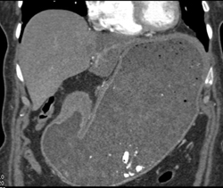 Antral Carcinoma - CTisus CT Scan