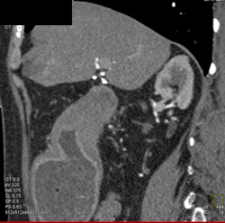 Antral Carcinoma - CTisus CT Scan