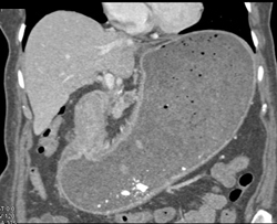 Antral Carcinoma - CTisus CT Scan