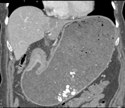 Antral Carcinoma - CTisus CT Scan