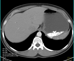 Tootsie Rolls in Stomach - CTisus CT Scan