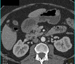 1 Cm GIST Tumor - CTisus CT Scan