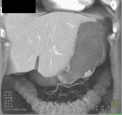 Gastric Adenocarcinoma - CTisus CT Scan