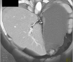 Gastric Adenocarcinoma - CTisus CT Scan