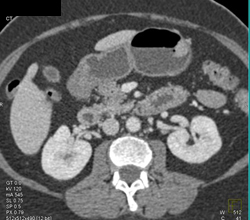 Gastric Adenocarcinoma - CTisus CT Scan