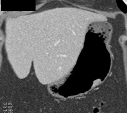 Gastric Adenocarcinoma - CTisus CT Scan