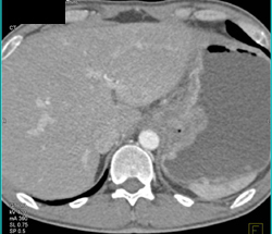 Gastric Carcinoma With Peri-gastric Nodes - CTisus CT Scan