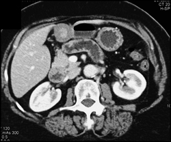 Antral Pseudomass - CTisus CT Scan