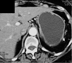 Normal Stomach - CTisus CT Scan