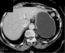 Normal Stomach - CTisus CT Scan