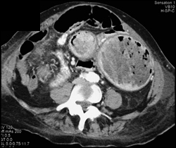 Canada Cronkite Syndrome With Gastric Masses - CTisus CT Scan