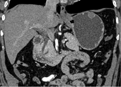 GIST Tumor - CTisus CT Scan