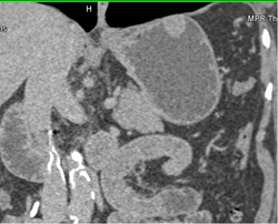 GIST Tumor - CTisus CT Scan